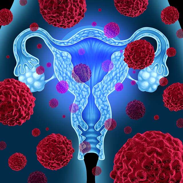 Gynecological Cancer Treatment