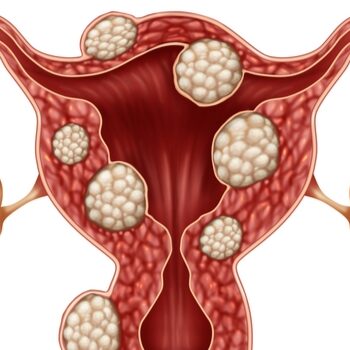 best treatment for fibroids in dhanori